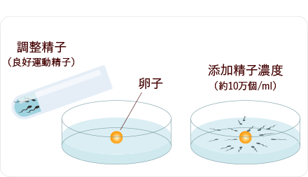 通常媒精法のイメージ