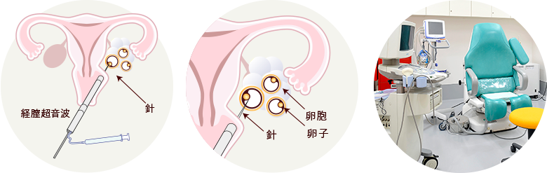 採卵の実際